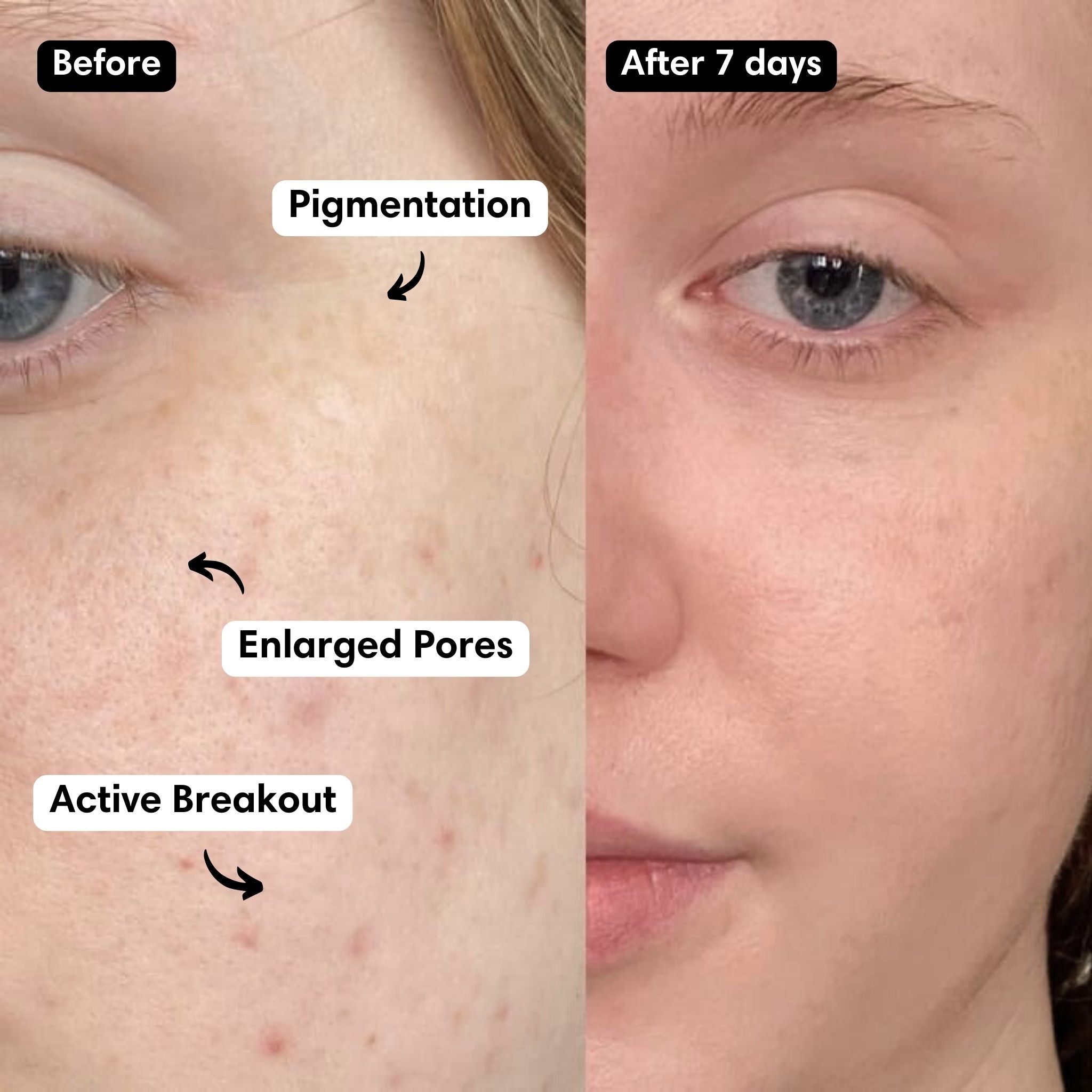 A 10% PAD solution brightening serum that relieves redness, fades hyperpigmentation and minimizes the look of enlarged pores.