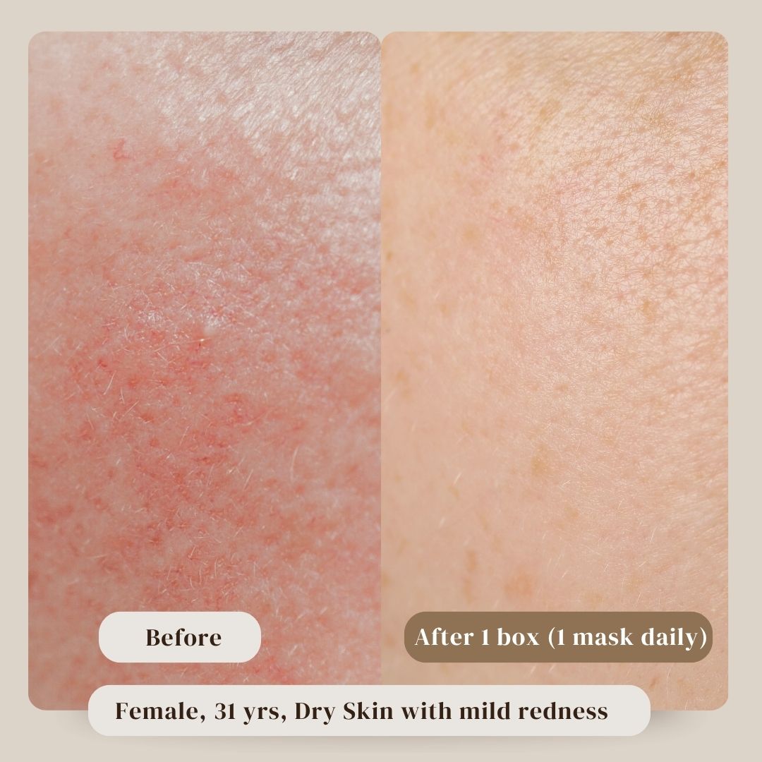 Before and after comparison of dry skin with mild redness on a beige background. Results are significant, with dry skin recovery within 1 box of usage.
