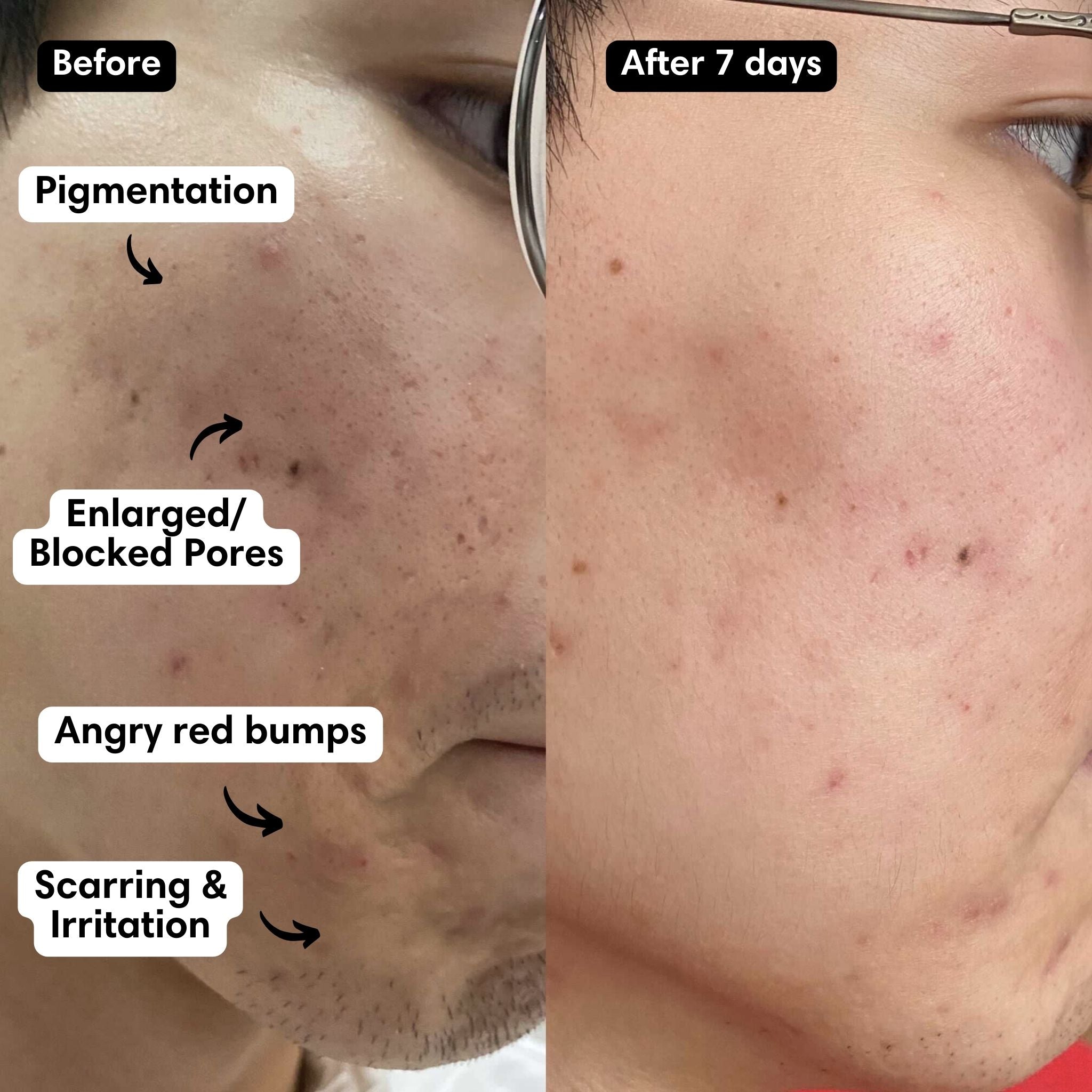 A 10% PAD solution brightening serum that relieves redness, fades hyperpigmentation and minimizes the look of enlarged pores.