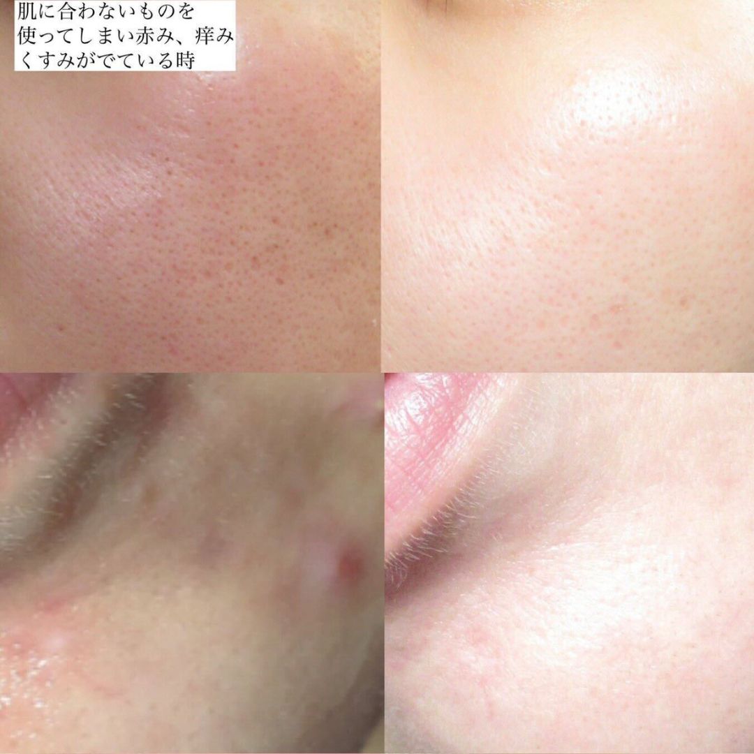 A 10% PAD solution brightening serum that relieves redness, fades hyperpigmentation and minimizes the look of enlarged pores.