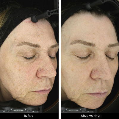 before and after 28 days significant improvement in skin after using omega repair cream to minimize skin sensitivity and dryness and pigmentation issues